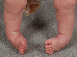 Chromosomal abnormality found for inherited clubfoot