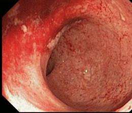 Colitis patients diagnosed later in life tend to have better disease outcomes