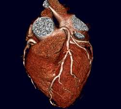 Combo high-tech CT scans just as good as older imaging to detect coronary artery disease