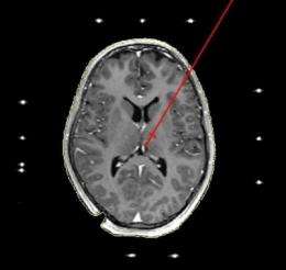 Deep brain stimulation successful for treatment of severely depressive patient