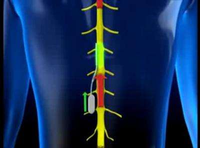 New miniature smart chip implant to combat chronic pain