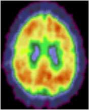 Exercise may reduce Alzheimer?s disease brain changes