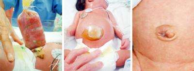 Innovative treatment for abdominal birth defect prevents scarring
