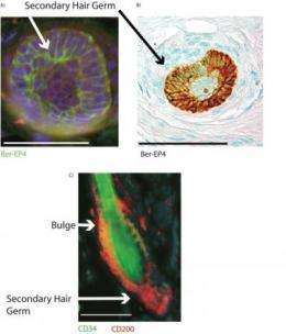 Male pattern balding may be due to stem cell inactivation, according to Penn study
