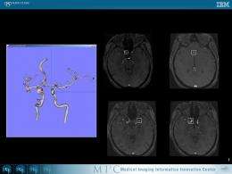 Mayo Clinic and IBM advance early detection of brain aneurysms