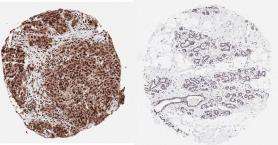 Newly Discovered Protein Function Linked to Breast Cancer