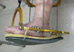New treatment for crippling diabetic Charcot foot