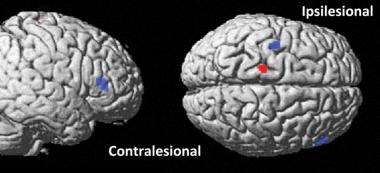 Noninvasive brain stimulation helps improve motor function in stroke patients
