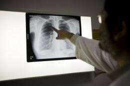 Older people and those with HIV are more vulnerable to tuberculosis