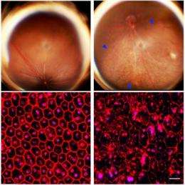 Pivotal discoveries in age-related macular degeneration