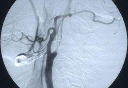 Surgery can lead to long-term reduction in stroke risk