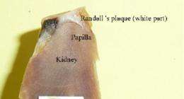 The role of calcium in Randall’s plaques (kidney stones)