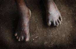 Tiny East Timor declares war on leprosy (AP)
