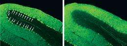 Unearthing a pathway to brain damage