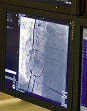 URMC First in Nation to Implant Heart Failure Device That Offers Glimpse of Personalized Medicine