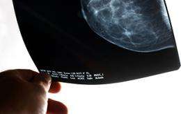 Women With Variants in 'CLOCK' Gene Have Higher Risk of Breast Cancer