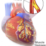 A new study could help prevent heart attacks in diabetic patients thumbnail