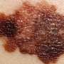 Mayo Clinic Minute: Learning the 'ABCDEs' of melanoma