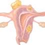 essay on endometrial cancer