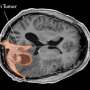 Prolonged use of certain hormone drugs linked to increased brain tumor risk