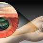 Charge batteries through skin with permanent implantable device concept