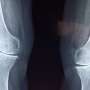 new research on osteoporosis