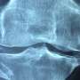 new research knee osteoarthritis