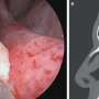 Doctors find tooth growing inside a patient's nose