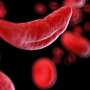Researchers publish final results of key clinical trial for gene
therapy for sickle cell disease
