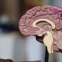 What causes multiple sclerosis? Researchers are closer to figuring it out thumbnail