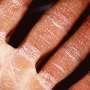Allergic asthma and eczema linked to heightened risk of osteoarthritis