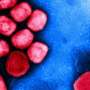 Self-sampling proves effective in diagnosing asymptomatic mpox