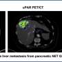 New PET tracer shows promise for uPAR-targeted therapy of
neuroendocrine neoplasms