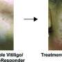 New study reveals characteristics of stable Vitiligo skin disease thumbnail