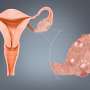 Review paves the way for better diagnosis and care for polycystic
ovary syndrome