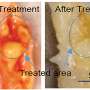 Ultrasound-assisted laser technique vaporizes artery plaque thumbnail