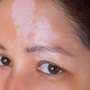 any new research on vitiligo