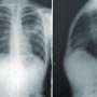 case study of a lung cancer patient