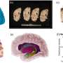 New computer tools can reconstruct 3D brain from biobank photos thumbnail