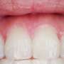 for research purposes prevalence of periodontal disease means