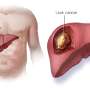 research about cancer of the liver
