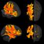 Researchers identify specific regions of the brain damaged by high blood pressure, involved in mental decline, dementia