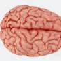 brain stroke case study