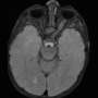 Epilepsy drug prevents brain tumors in mice with neurofibromatosis
type 1