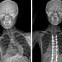 Researchers uncover key genetic clue in adolescent idiopathic
scoliosis