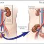 new research about kidney disease