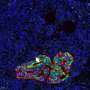 new research for pancreatic cancer