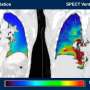 New imaging software improves lung diagnosis for 30% of patients who can't tolerate contrast dye