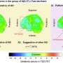 research about lung cancer