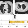 research about lung cancer